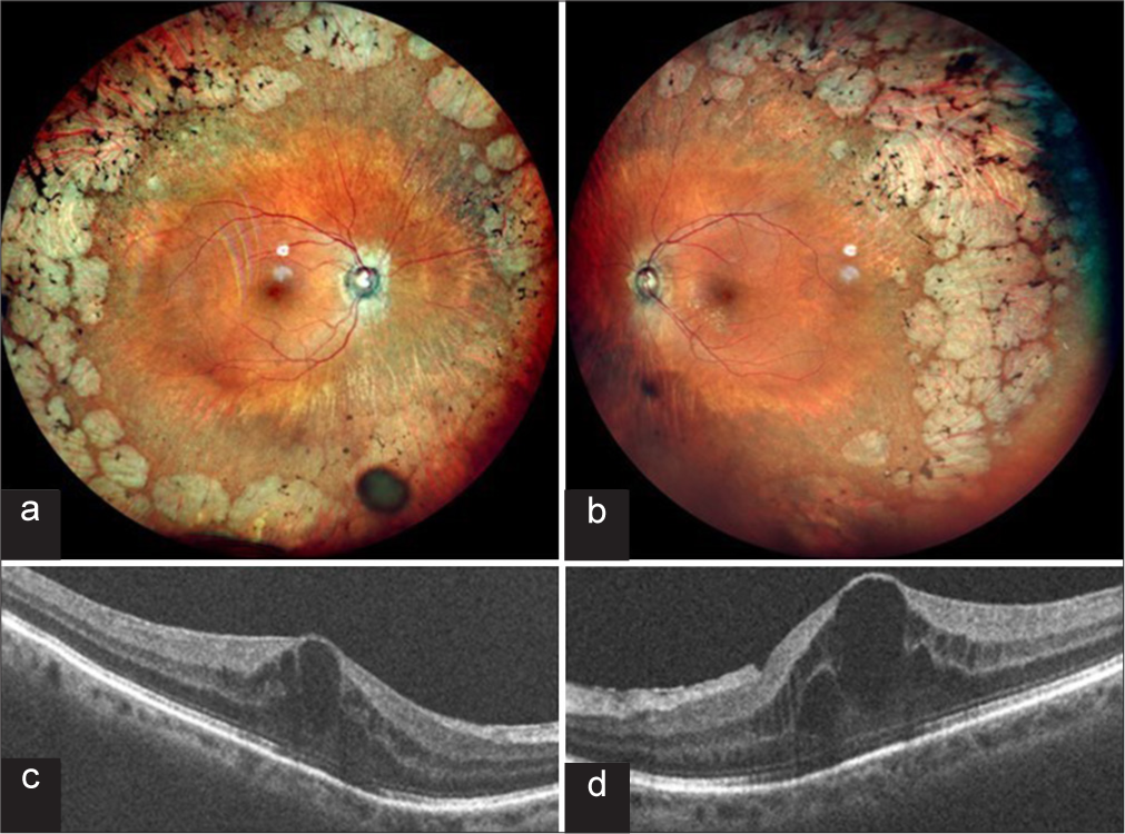 Dexamethasone implant for the treatment of cystoid macular edema secondary to gyrate atrophy in an elderly patient