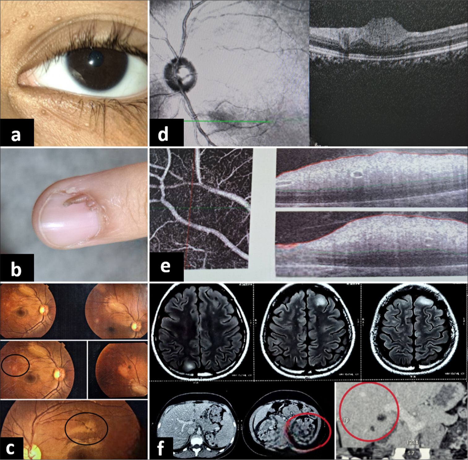 The usual suspects: A case series on bilateral astrocytic hamartomas in tuberous sclerosis