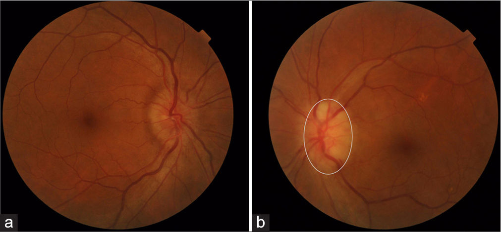 Sarcoidosis masquerading non-arteritic ischemic optic neuropathy