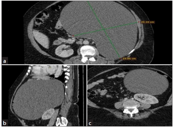 Gigantic adrenal pseudocyst: A case report