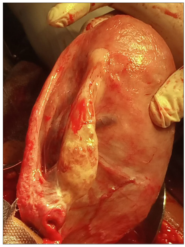 Incidental finding of left adnexum agenesis observed at cesarean section: A case report