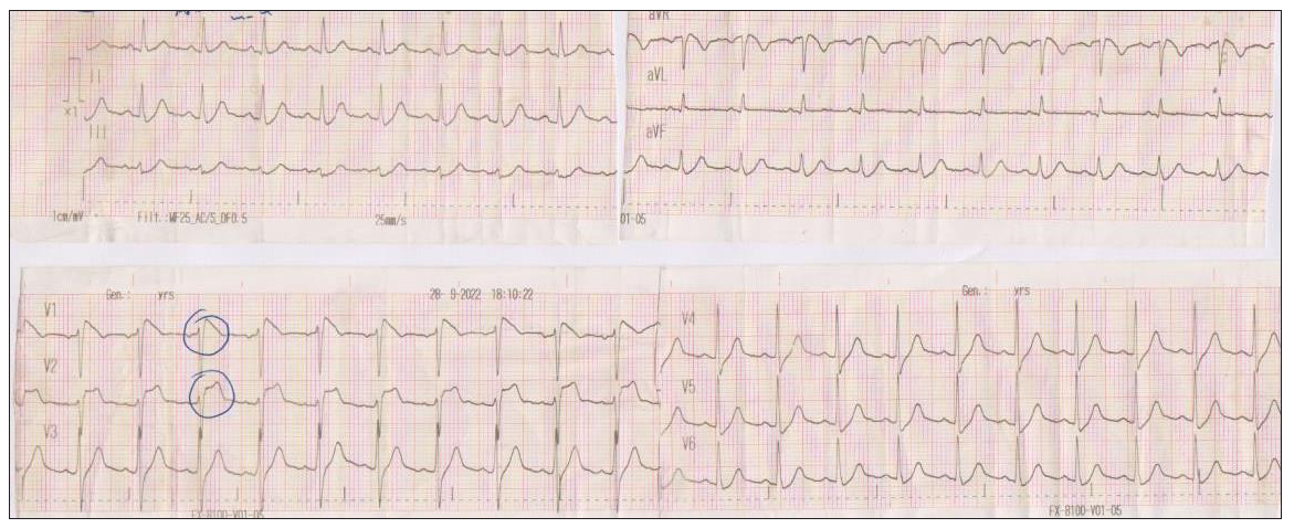 COVID-19 infection and exercise reveal the ECG form of Brugada syndrome: A two-case reports