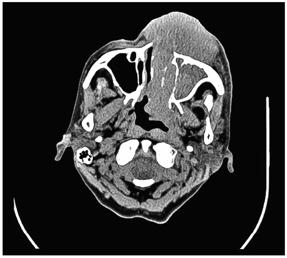 A case of diffused large B-cell lymphoma in an elderly patient successfully treated with R-mini-CHOP