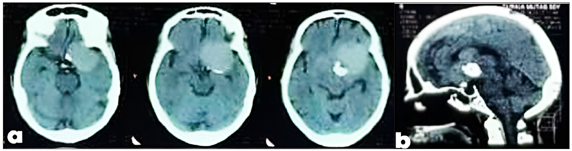 Suprasellar dermoid cyst masquerading as tumor: A case report