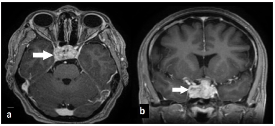 Pituitary carcinoma with multiple metastases: A case report and literature review