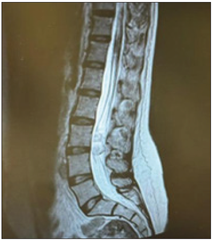 An unusual late complication of peridural anesthesia: The case of a subdural spinal epidermoid cyst: A case report and literature review