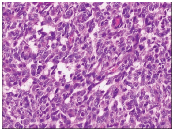 BCOR overexpression in pediatric sarcomas- a morphologic continuum of mixed round and spindle cell tumors