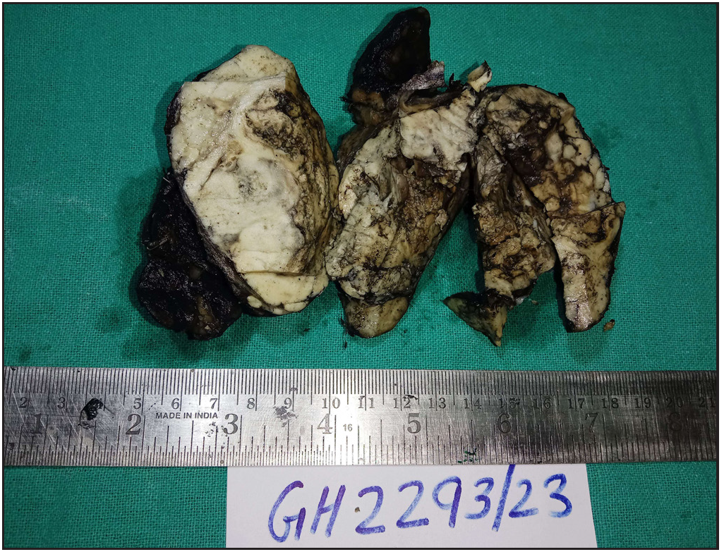 Sarcoma of the thyroid co-occurrence with Carcinoma (Carcinosarcoma)