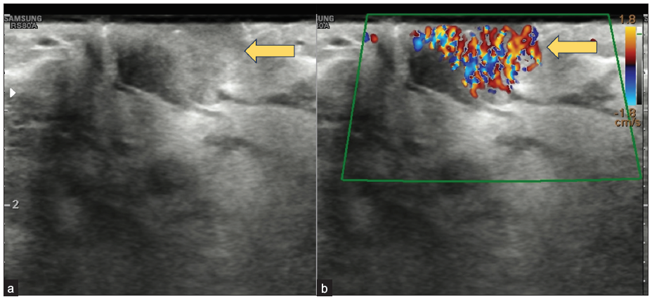 Case report of a rare benign breast lesion: Unveiling nipple adenoma