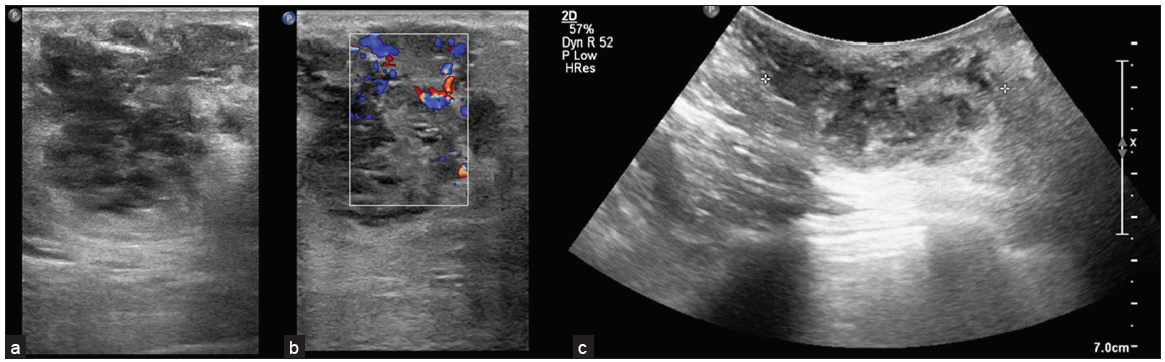 A rare case of primary angiosarcoma of breast with histopathology correlation