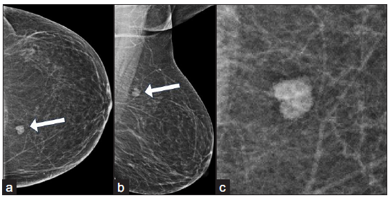 Usefulness of intralesional contrast injection as a prebiopsy confirmation technique in a case of breast hemangioma