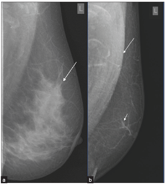 Illuminating the obscure: An imaging study of male breast diseases