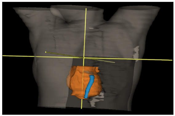 Dosimetric analysis of LAD dose in left-sided breast cancer radiotherapy with deep inspiratory breath hold