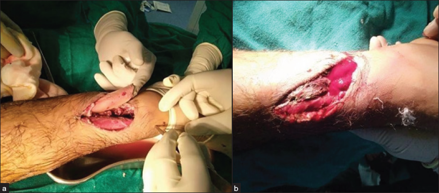 External Fixator vs. Locking Compression Plate in “Supracutaneous” Mode for Open Distal Tibial Fractures: A Comparison on Economics, Union, Functional Outcome and Complications