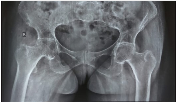 Comparative Study of Pre-operative, Operative, and Post-operative Parameters of Single and Staged Bilateral Total Hip Replacement