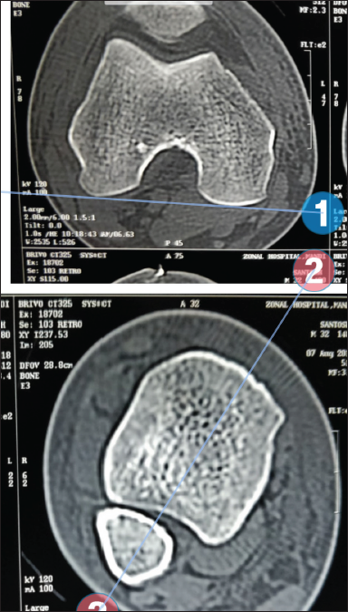 Tibial Malrotation after Intramedullary Locked Tibia Nailing and its Computed Tomography-Based Assessment