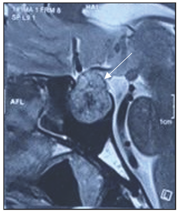 The Endoscopic Transsphenoidal Technique for Acromegaly: Evaluating Remission