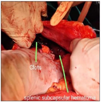 Splenic Rupture During Pregnancy: A Misdiagnosed, Rare Obstetrical Emergency