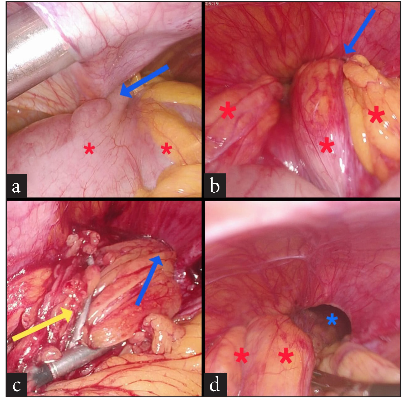 Morgagni-Larrey Diaphragmatic Hernia Masquerading as Calculous Cholecystitis – A Googly Tackled Laparoscopically