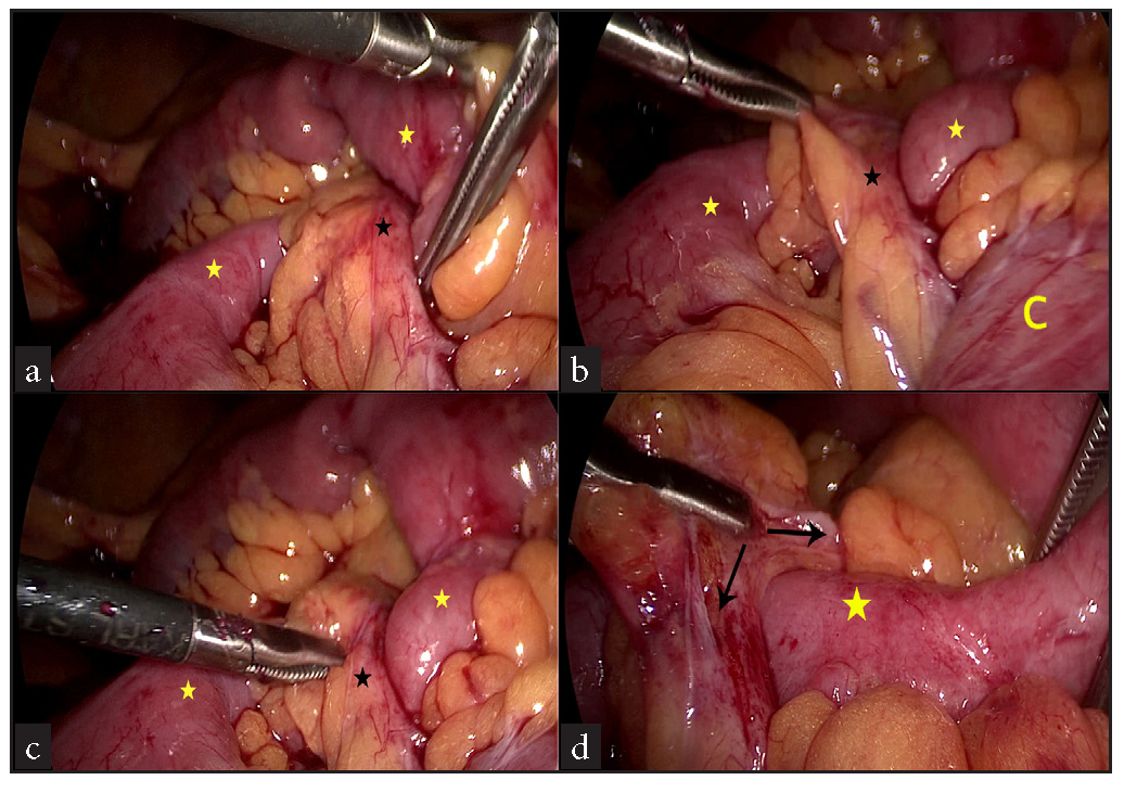 Acute Small Bowel Obstruction Due to Entrapment Under Appendices Epiploicae Tourniquet – Laparoscopic Management