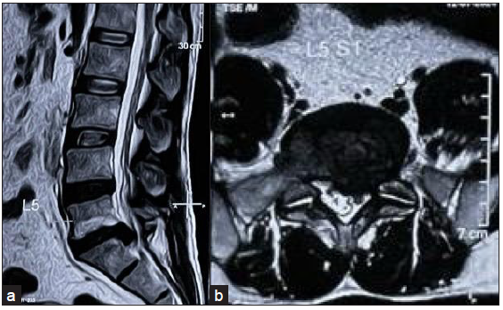 Clinical Outcomes of Unilateral Biportal Endoscopy in Lumbar Disc Herniation and Degenerative Lumbar Canal Stenosis