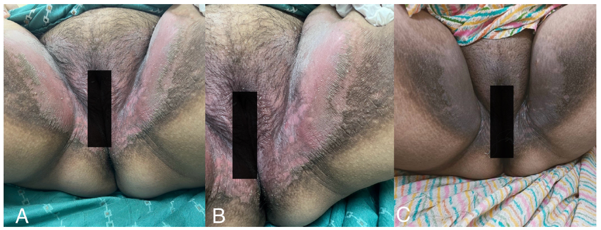 Extensive Intertrigo and Irritant Contact Dermatitis of Groins in Pregnant Female Due to Overuse of Feminine Hygiene Products