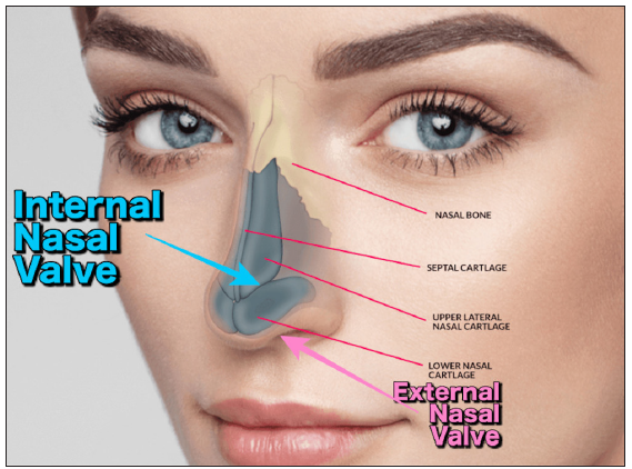 Can the Internal Nasal Valves Method Be a Game Changer for Preventing Respiratory Tract Infections?