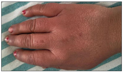 Carbamazepine-Induced Peripheral Angioedema: Case Report of a Rare Adverse Drug Reaction