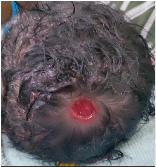 Aplasia cutis congenita of scalp