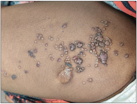 Lymphangioma circumscriptum – The “Frog Spawn” dermatosis