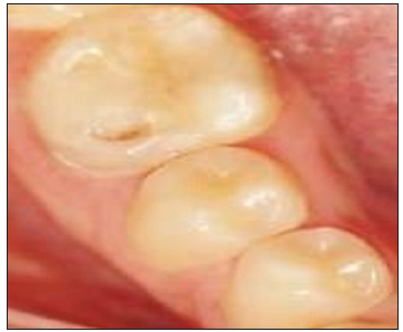 The Middle Mesial Canal: Combined Endodontic and Restorative Treatment Approach - A Case Report