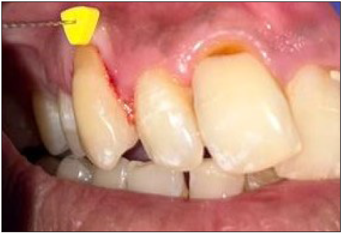 A Novel Approach of Microneedling and Glutathione Injection in the Management of Thin Gingival Phenotype – A Case Report