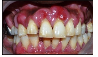 Amlodipine-Induced Gingival Enlargement – A Case Report
