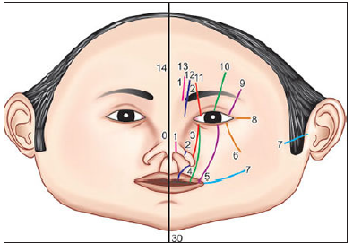 Tessier 7– Facial Cleft with Macrostomia: A Rare Case Report