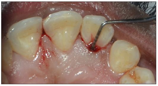 Palatogingival Groove: A Plaque Trap Leading to Bone Loss in a Maxillary Lateral Incisor – A Rare Case Report