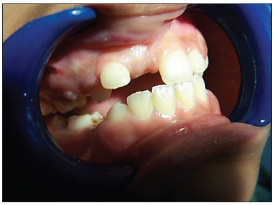 Uncommon Case of Supernumerary Teeth and their Management: A Rare Clinical Case Report