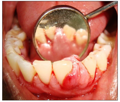 Management of Pyogenic Granuloma in the Mandibular Anterior Region Using Diode Laser