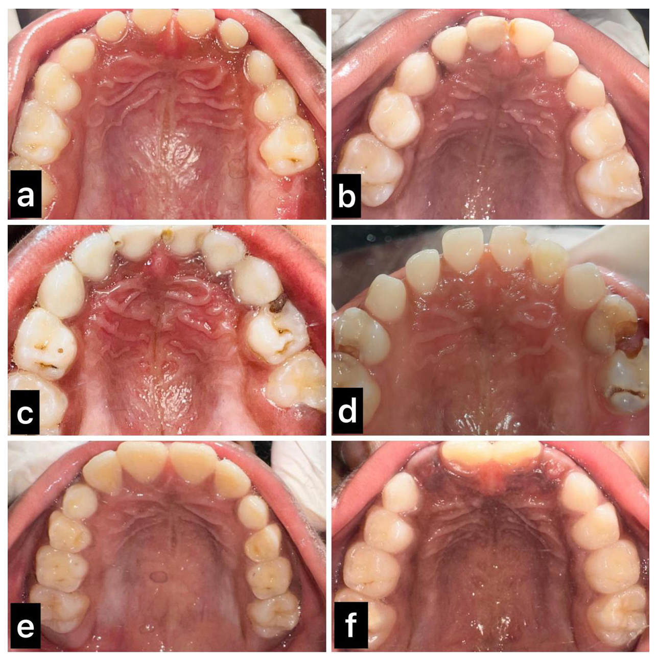 Morphological Characteristics of the Incisive Papilla in Pediatric Forensic Odontology: A Cross-Sectional Study