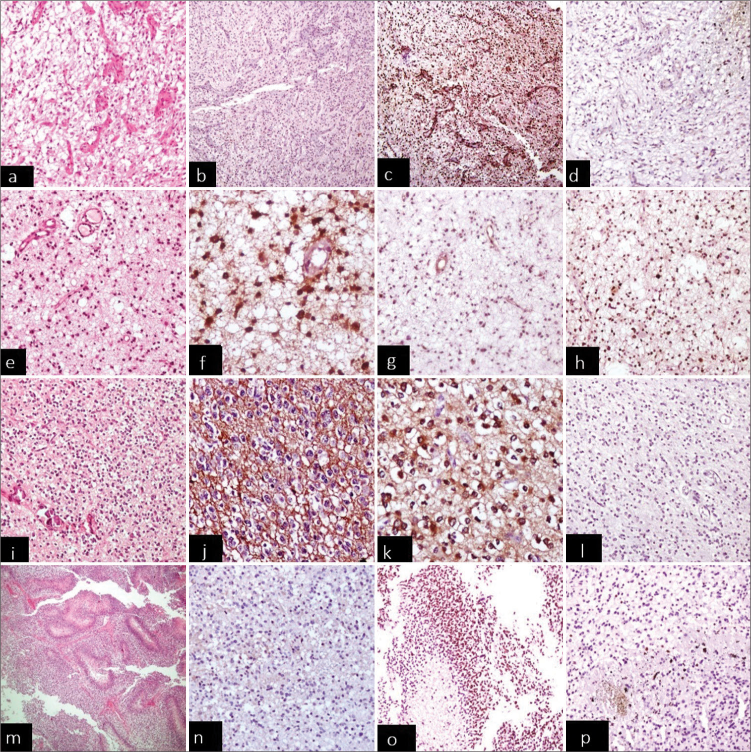 Surrogate immunohistochemistry markers in adult gliomas – Experience in a tertiary care hospital