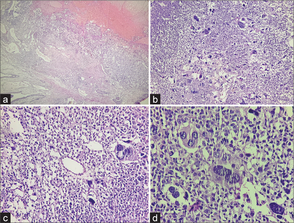 Prostatic perivascular epithelioid cell tumor: A rare entity and literature review