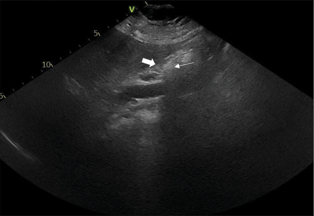 Actinomycosis of the gallbladder: A rare case report and literature review