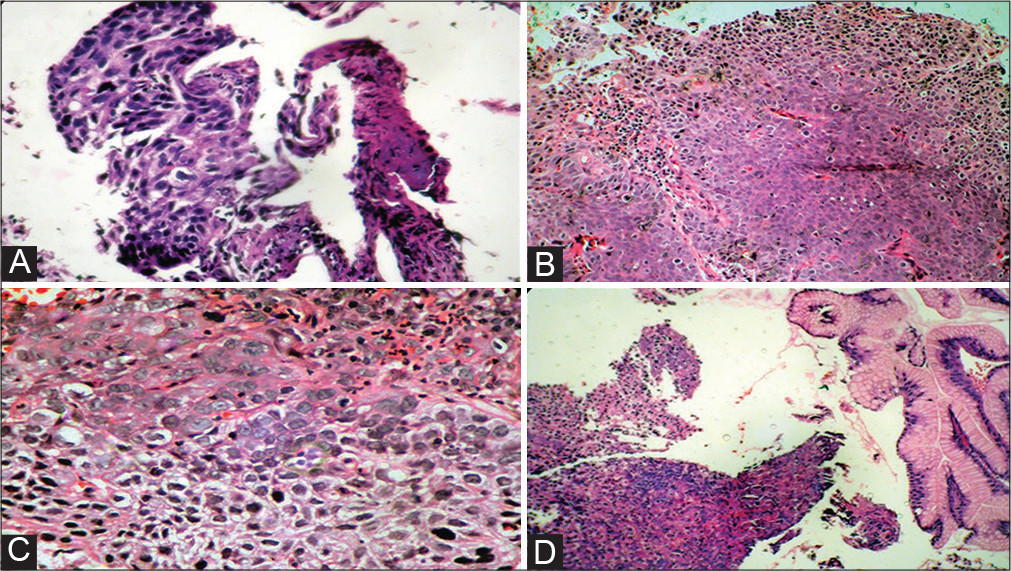 Evaluation of cyclooxygenase-2, P53, vascular endothelial growth factor, and nitric oxide synthase-2 in angiogenesis and growth of tobacco-related malignancies