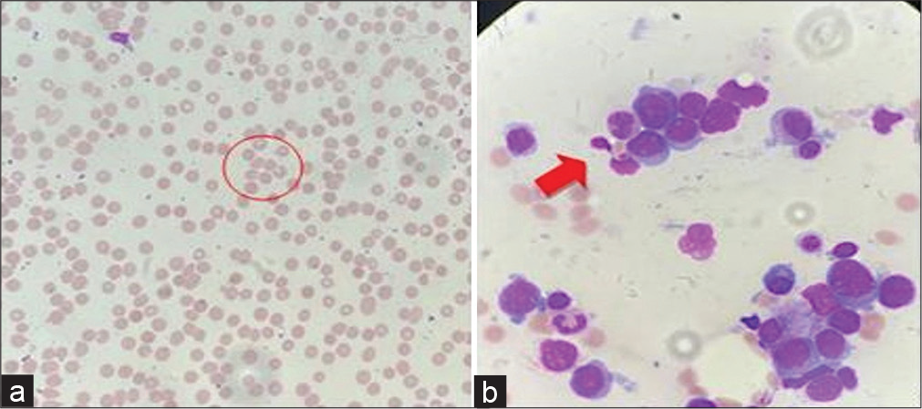 Burkholderia vietnamiensis causing bacteremia in patients suffering from B-cell acute lymphocytic leukemia: A case series and review of literature