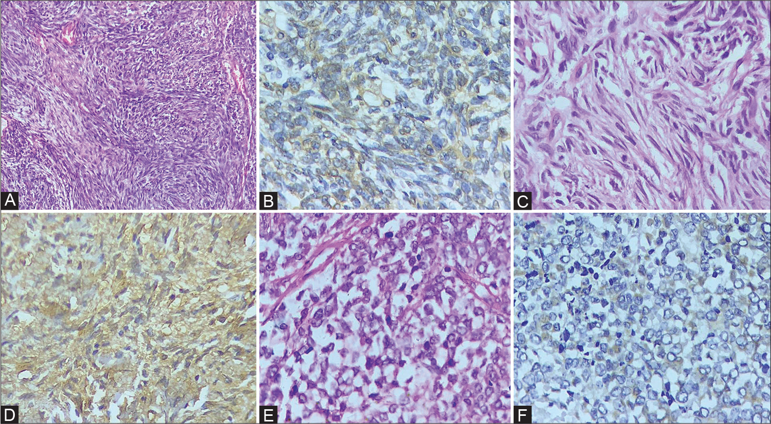 Expression of PD-L1 in malignant soft tissue neoplasm and their correlation with clinicopathological parameters