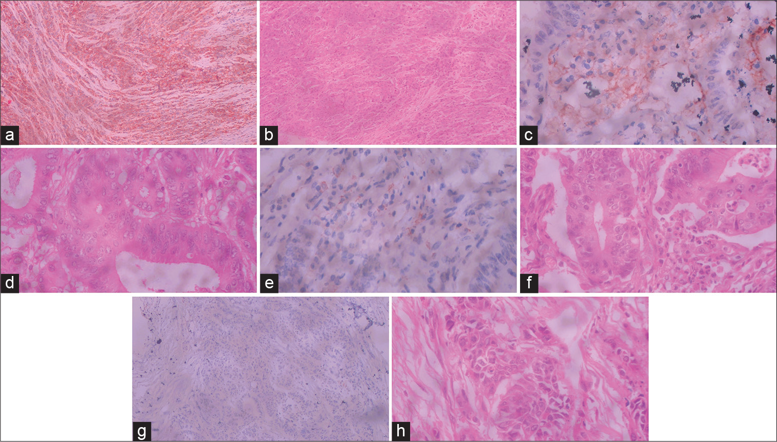 Immunohistochemical expression of programmed death ligand (PD-L1) is associated with poor differentiation, higher tumor-infiltrating lymphocytes, and higher t and n stage in colorectal adenocarcinoma: A single-center analytical study of 52 cases in South India