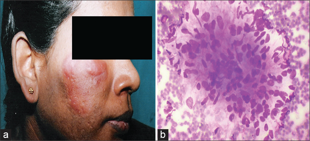 A cytohistopathological correlation study of skin lesions in leprosy: An experience in a tertiary care hospital in South India