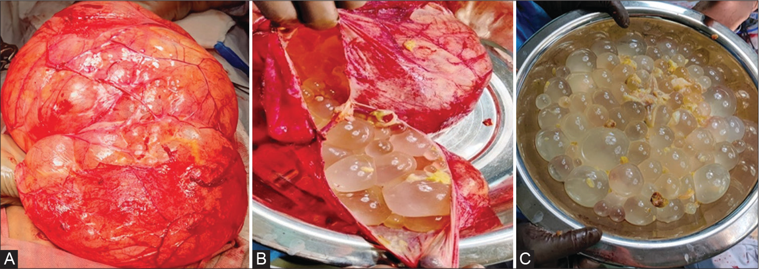 Liver and mesenteric hydatid cyst in a child