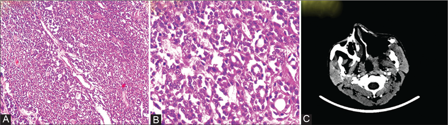 Metastasis of maxillary sinus adenoid cystic carcinoma to the humerus bone—A rare case report