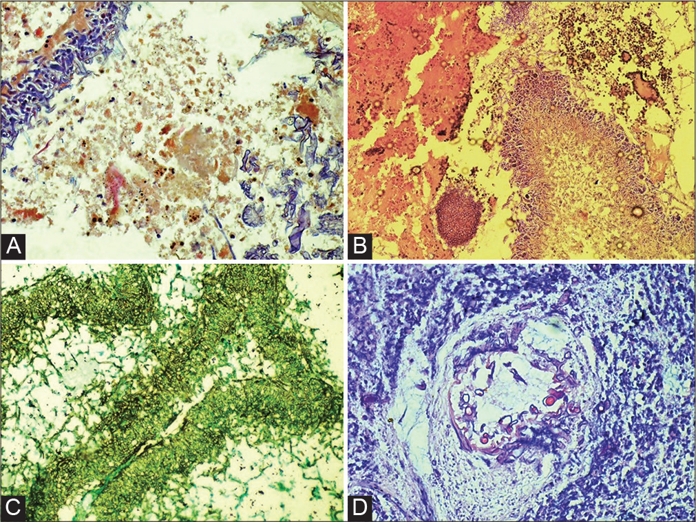 Invasive mixed fungal disease after covid-19: A series of seven cases