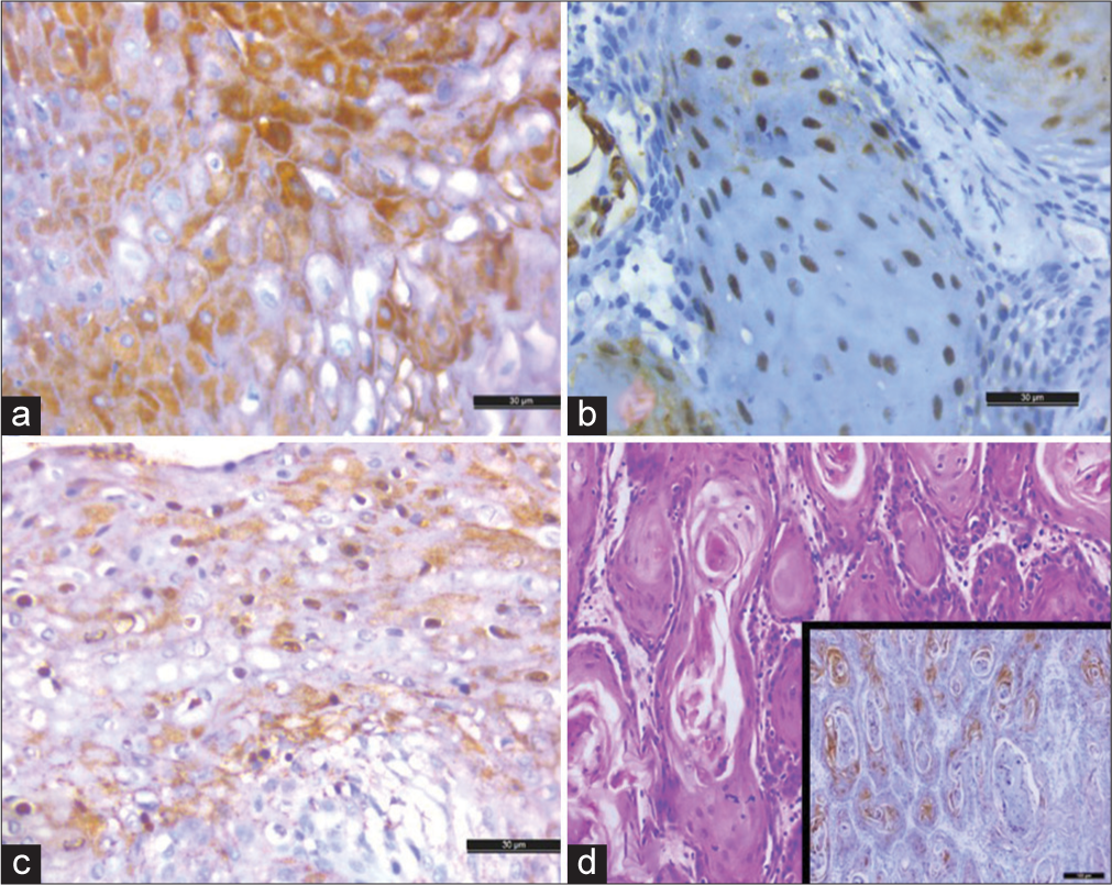 Immunohistochemical evaluation of tumor hypoxia and angiogenesis: Pathological significance and prognostic role in head and neck squamous cell carcinomas